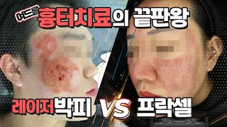 여드름흉터원정대 15탄. 여드름흉터 치료의 끝판왕. 레이저박피 Vs 프락셀