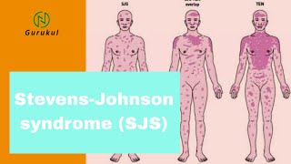 Stevens-Johnson Syndrome (SJS)