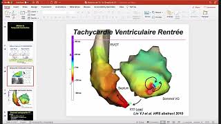 Ablation De Tachycardia Ventriculaire