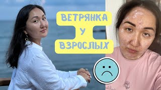 Ветрянка у взрослых