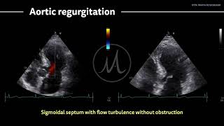 〖Echocardiography〗 Sigmoidal septum & mild aortic regurgitation