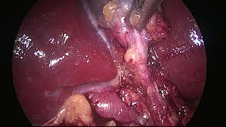 laparoscopic cholecystectomy in less than 10 minutes   unedited video