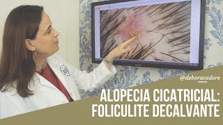 Alopecias  Cicatriciais: Foliculite Decalvante