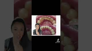 Can you remove tartar off your teeth at home???