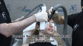 Forever Young BBL IPL Photofacial Demo 48 Sherra Michelle - A E Skin - Encino, CA - 818-835-1833