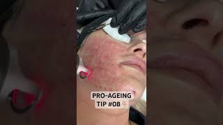 WILL MY ACNE EVER HEAL? Can I prevent it? #acnescarring #acne #acnescarremoval #lasertreatment