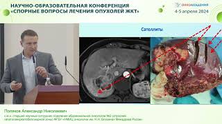 Тактика при резектабельной внутрипеченочной холангиокарциноме. Поляков А.Н.