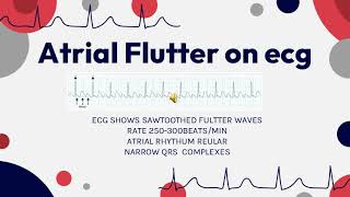 ATRIAL FLUTTER