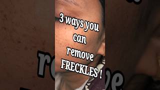 Remove your freckles like a dermatologist @DrArifMDDermatologist #freckles #viral