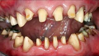 28 Same Day Crowns - Full Mouth Rehab