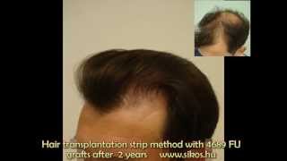 Hajbeültetés eredménye dr. Sikos Hair transplant result 4689 grafts , Budapest, Hungary