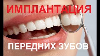 Имплантация переднего зуба. Удаление зуба с поврежденным корнем с одномоментной имплантацией