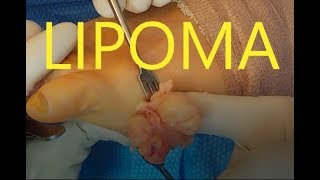 Foot Lipoma Removed by a Foot and Ankle Surgeon - Dr. Kolodenker - Orange County - Irvine, CA