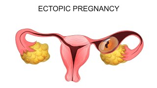 Understanding Ectopic Pregnancy: Symptoms & Treatment