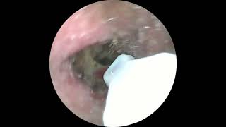 Swimmer's Ear | Infection Debris Drainage Earwax Removal | Warning | Discretion Advised