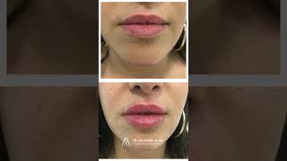 Relleno de Labios con ácido hialurónico | Medicina Estética