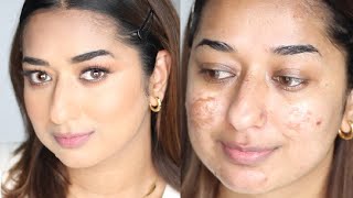 ✅ HINDI | HOW TO COVER ACNE PRONE SKIN ACNE SACRS & HYPERPIGMENTATION (IF You Want To)