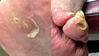 Not ONE, But TWO THICK CALLUS REMOVALS  On 90 YEAR OLD! | Dr. Kim, Kim Foot and Ankle