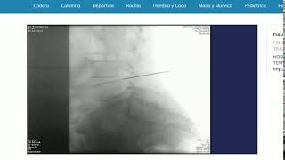 TRATAMIENTO ENDOSCÓPICO DE LA HERNIA DISCAL