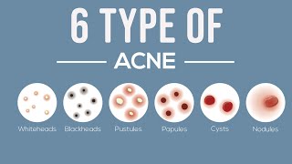 6 Type Of Acne |  How To Treat Them