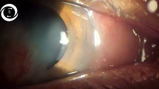 Pedicle conjunctival flap for infectious Keratitis