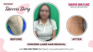 Best Laser Hair Removal Treatment  | Real Patient Results | Sakhiya Skin Clinic