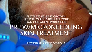 Microneedling w/PRP (platelet rich plasma) BEST anti-aging treatment FULL process✨for ALL skin types