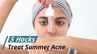 Treat Summer Acne & Pimples | Hacks for Acne Prone Skin