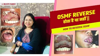 OSMF reverse होता है या नहीं ||