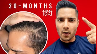 My 20 Months Hair Growth|MINOXIDIL|FINASTERIDE|results|TRANSPLANT|RECEDING|Hair|Line|HairFall|patch