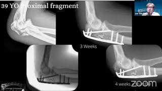 Proximal Ulnar Fractures and Dislocations