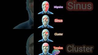 🌟 Different types of headaches 🧠:sinus, migraine, tension, and cluster headaches. #health