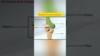 Patella Fracture Repair