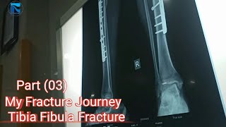 My Fracture Journey Part (03)|| Tibia Fibula Fracture Recovery ||  The Road To Recovery