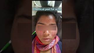 Chemical peel for acne || Before and after treatment || Real results