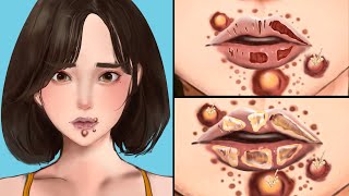 ASMR Treatment athlete foot Remove Worm & Maggot Hand Infected Severely Injured Animation Compassion