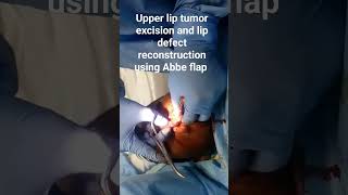 Lip defect reconstruction with Abbe flap #sierraleone #oralcancer