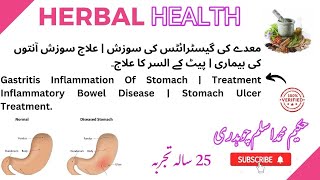 Gastritis Inflammation Of Stomach | Treatment Inflammatory Bowel Disease | Stomach Ulcer Treatment