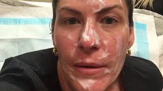 Microneedling with PRP - Numbing the skin