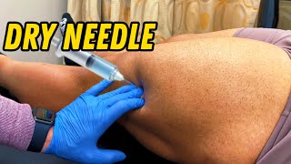 Dry Needle PAINFUL  With Christian Boivin