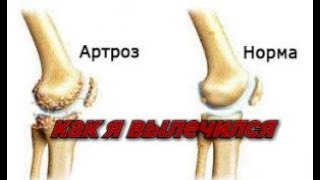 Артроз, Артрит, боли в коленях/восстановил здоровье растительной пищей