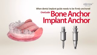 OneGuide Vertical fixation tools-Bone Anchor/Implant Anchor