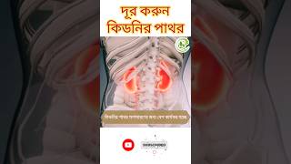 Kidney Stone Removal | কিডনির পাথর দূর করতে লেবুর রস