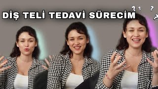 DİŞ TELİ TEDAVİ SÜRECİM| EN ZORLANDIĞIM ANLAR|