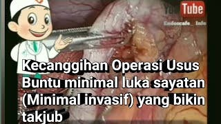 Laparoskopi usus buntu | Operasi Usus buntu Luka operasi sangat kecil