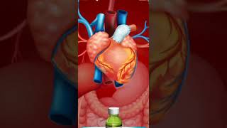 how-does-bypass-heart-surgery🤔🤔#CABG #hospital #patient #anesthesia #doctor #mbbsstudent #shorts