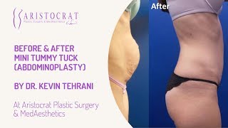 Mini Tummy Tuck Abdominoplasty Long Island, New York by Dr. Kevin Tehrani