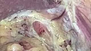 Axalaziyaya görə Laparoscopic Heller miotomya/ Heller myothomy for achalasia