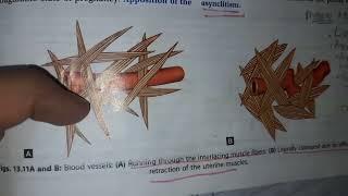 Postpartum Hemorrhage- Obstetrics Theory Exam Note for MBBS Final year