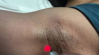 Laser hair removal on underarm Asian female in Raleigh, North Carolina